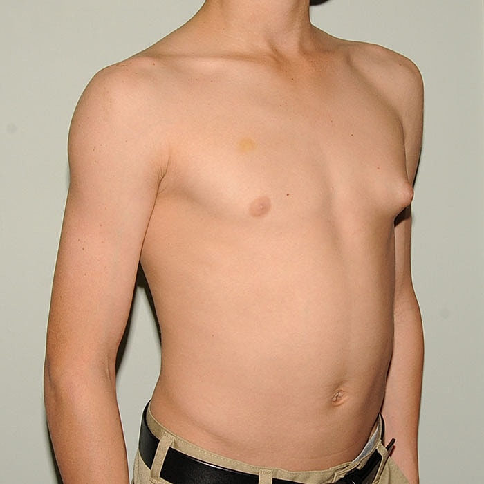 Gynecomastia Before & After