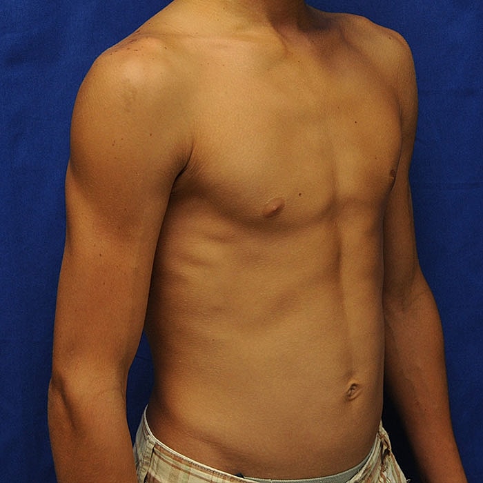 Gynecomastia Before & After