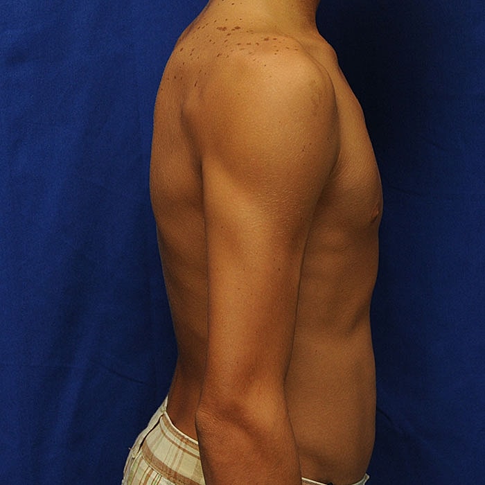 Gynecomastia Before & After