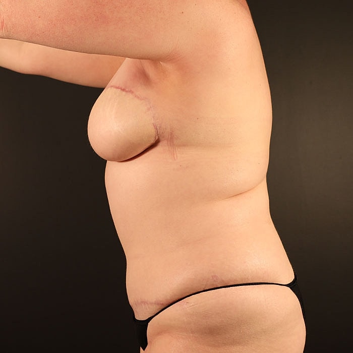 Unilateral Stacked DIEP Before & After