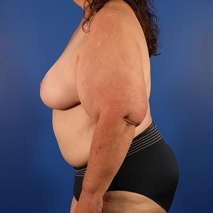 Unilateral Stacked DIEP Before & After