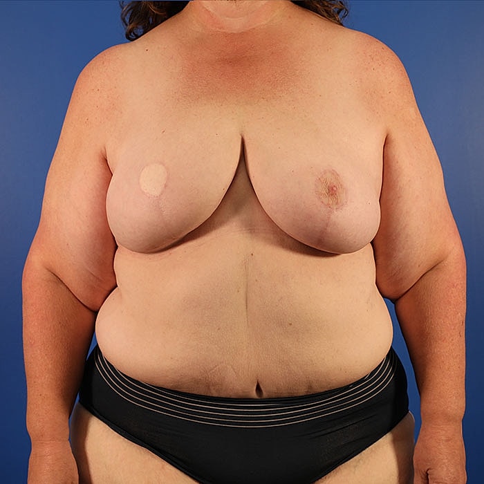 Unilateral Stacked DIEP Before & After