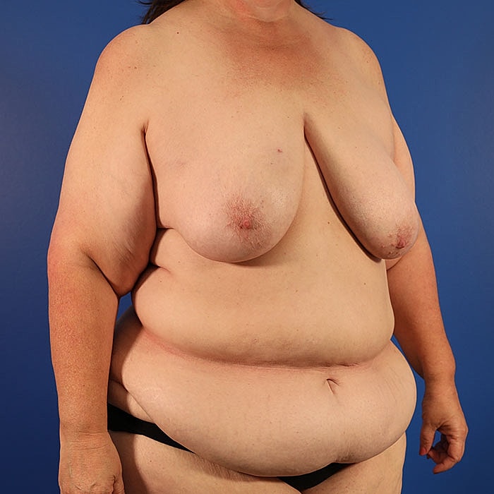 Unilateral Stacked DIEP Before & After