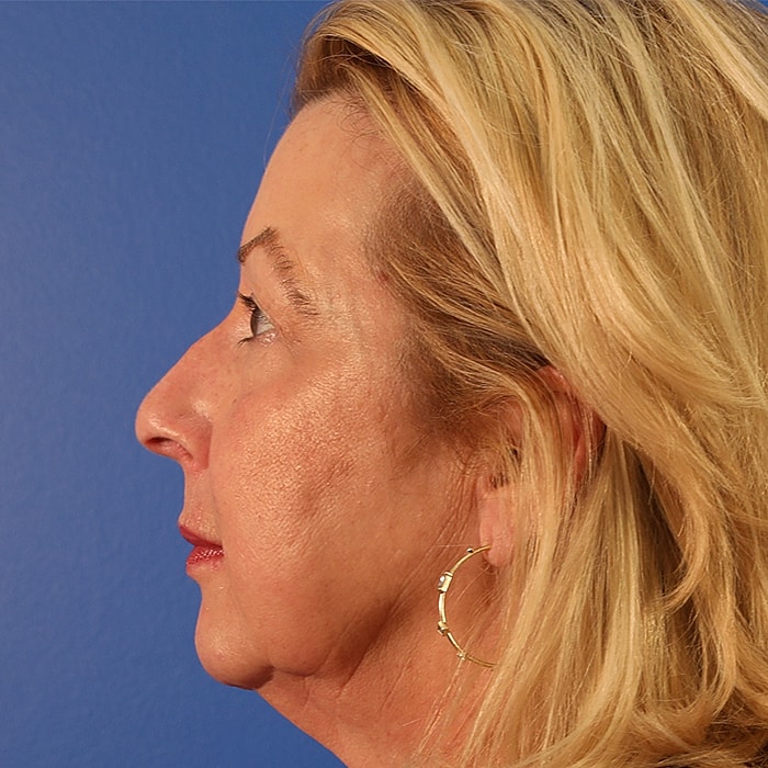 Blepharoplasty Before & After