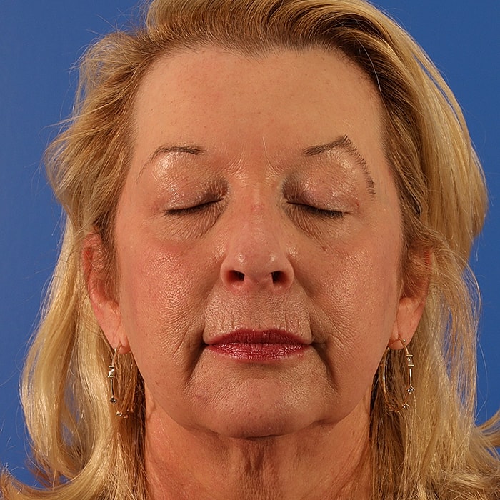 Blepharoplasty Before & After