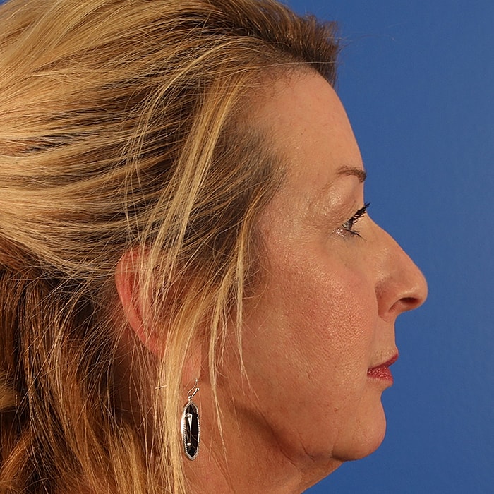 Blepharoplasty Before & After