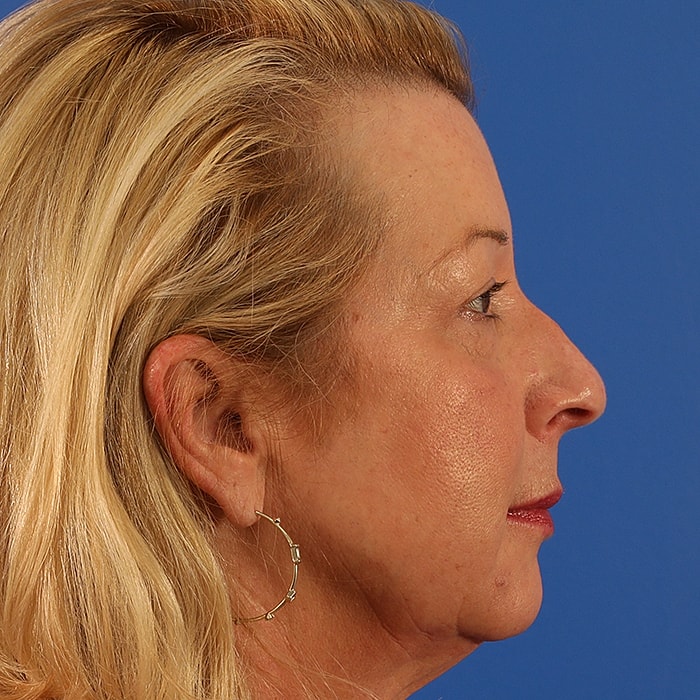Blepharoplasty Before & After