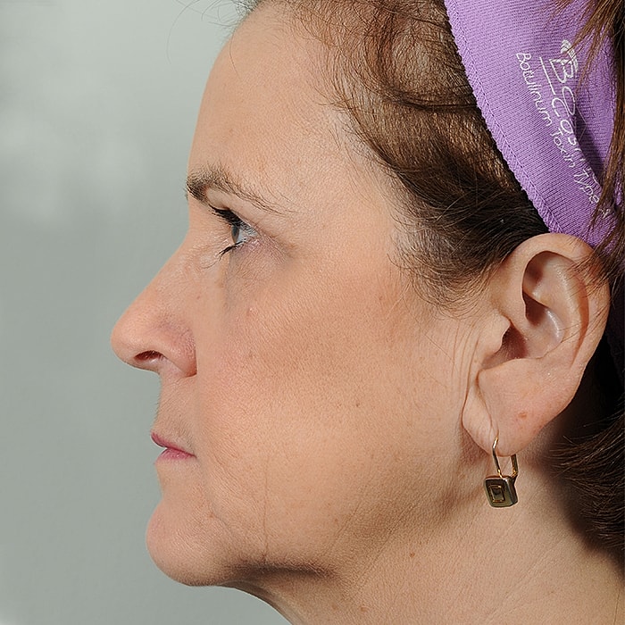 Blepharoplasty Before & After