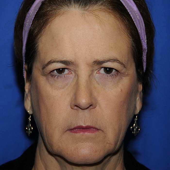 Blepharoplasty Before & After