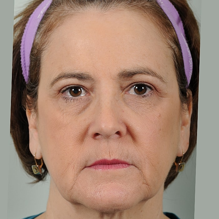 Blepharoplasty Before & After