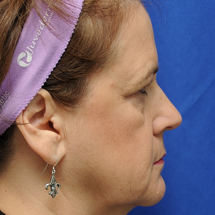 Blepharoplasty Before & After