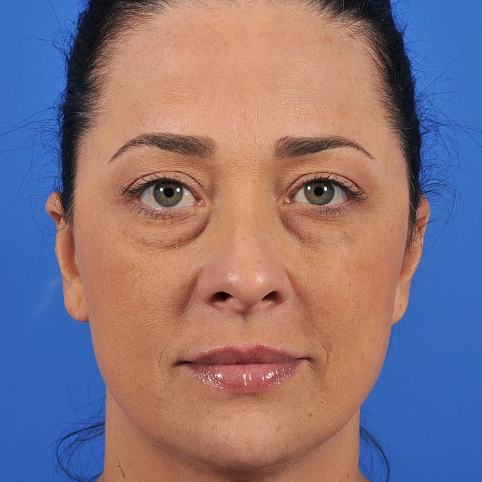 Blepharoplasty Before & After