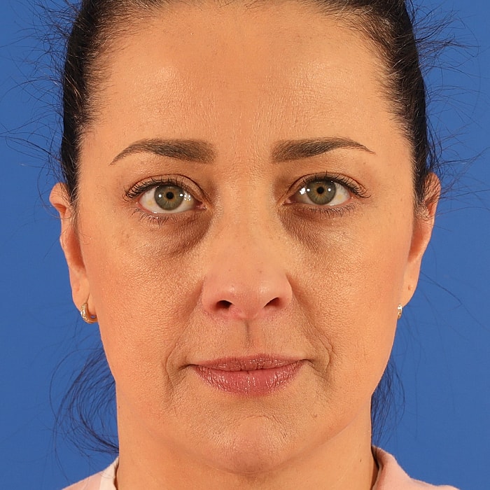Blepharoplasty Before & After