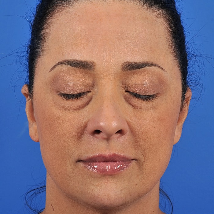 Blepharoplasty Before & After