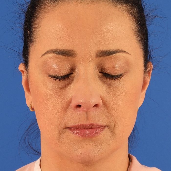 Blepharoplasty Before & After