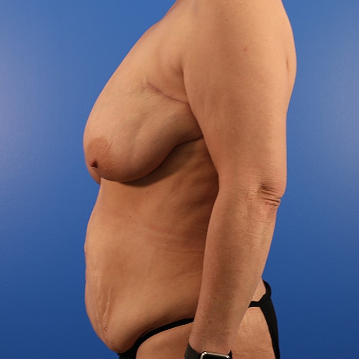 DIEP With Implants Before & After
