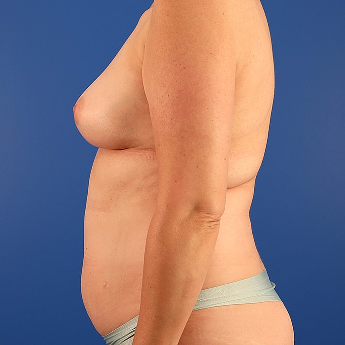 DIEP With Implants Before & After