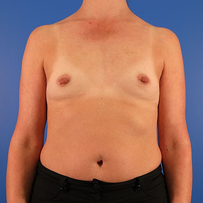 Breast Augmentation Before & After