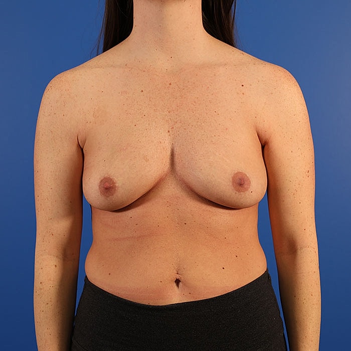 Breast Augmentation Before & After