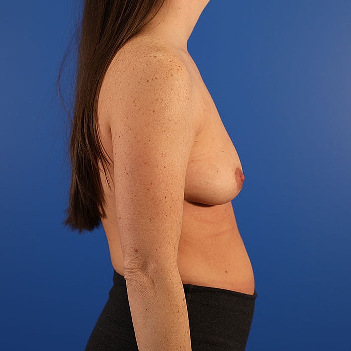 Breast Augmentation Before & After