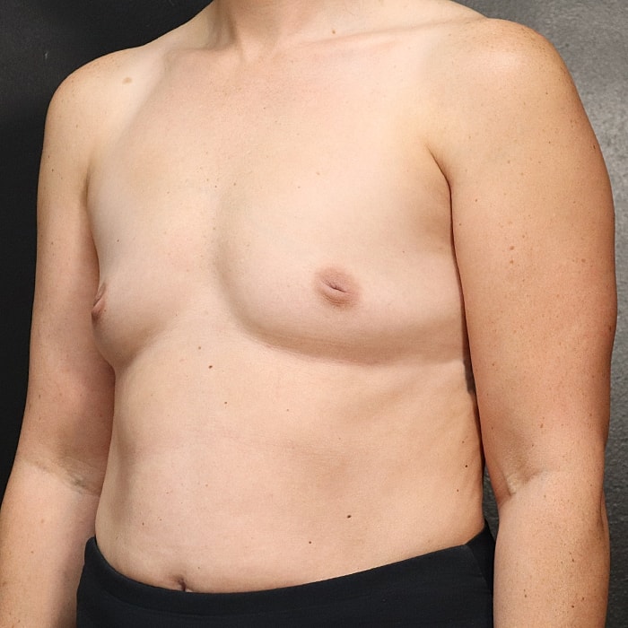 Breast Augmentation Before & After
