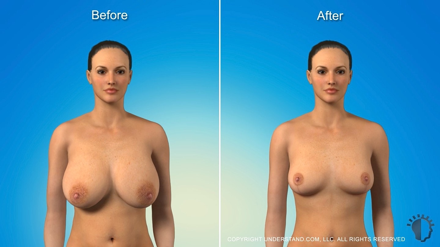 Before and after body transformation comparison image.