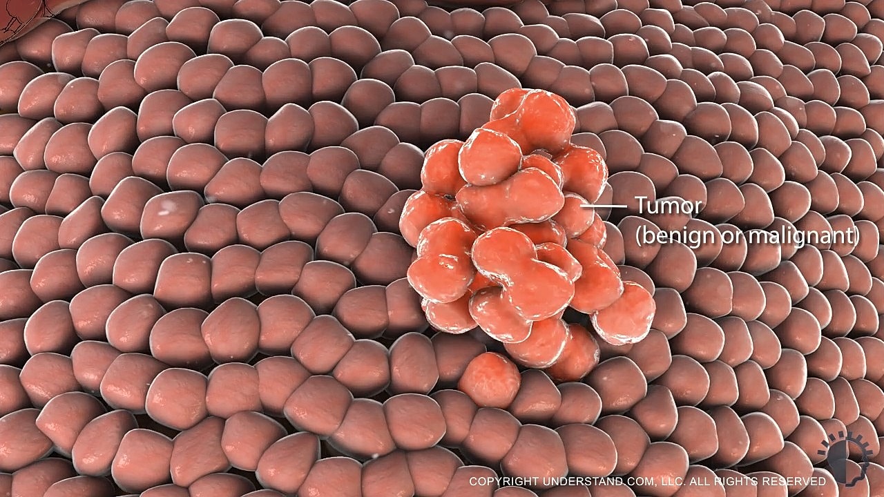 Cell structure with tumor highlighted in red.